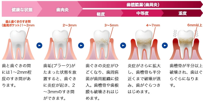 歯周病の進行イメージ図