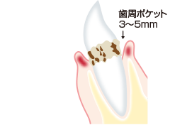 軽度歯周炎のイラスト