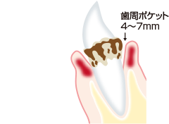 中等度歯周炎のイラスト