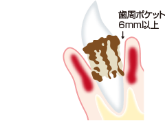 重度歯周炎のイラスト