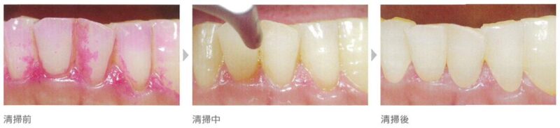 エアフローハンディ3.0による着色除去の効果（治療前後の比較）